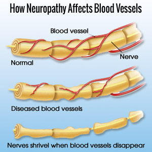 Peripheral Neuropathy Nerves image
